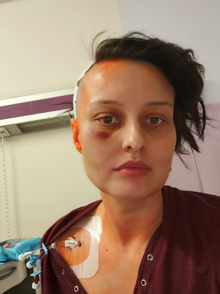 Katarzyna Kozioł z opatrunkiem na głowie i barku oraz z widocznym środkiem antyseptycznym pozuje do zdjęcia.